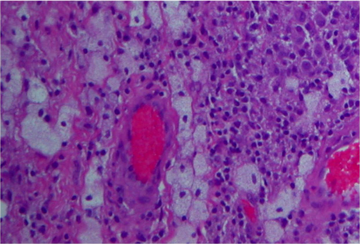 Giant Cell Tumor Of Tendon Sheath